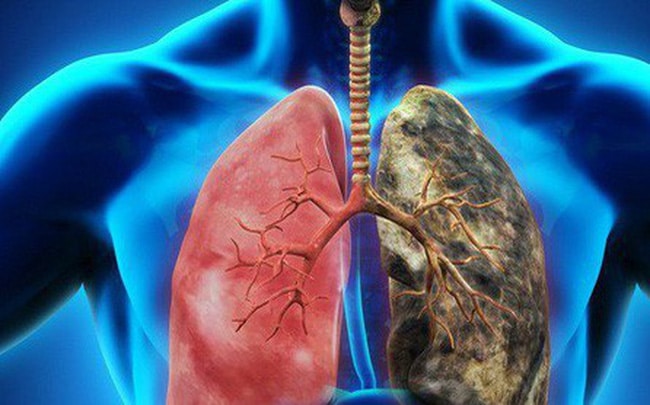Người mắc ung thư phổi có ăn yến được không?